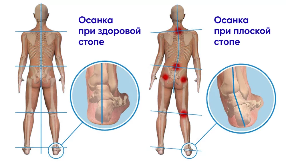 Плоскостопие имеет серьезные последствия для здоровья