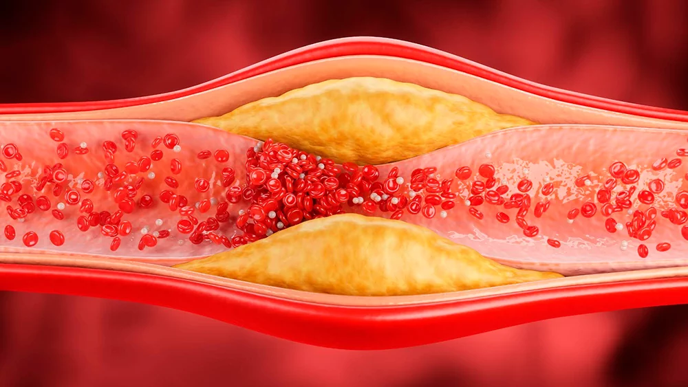 Lower Extremity Ischemia: When the Situation Becomes Dangerous