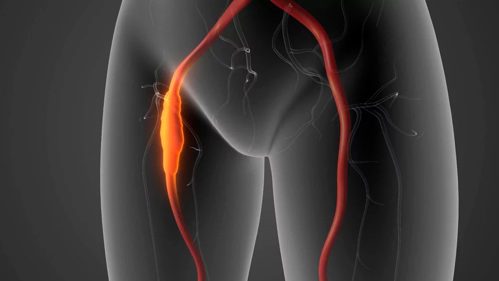 Peripheral Artery Disease: How to Avoid Amputation