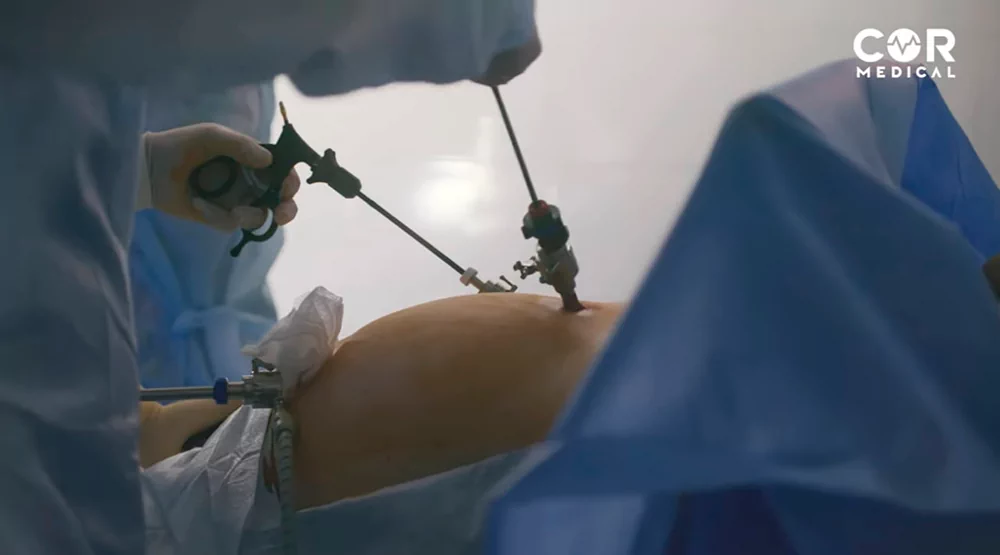 Postoperative Hernia: Why Does It Develop After Surgery?
