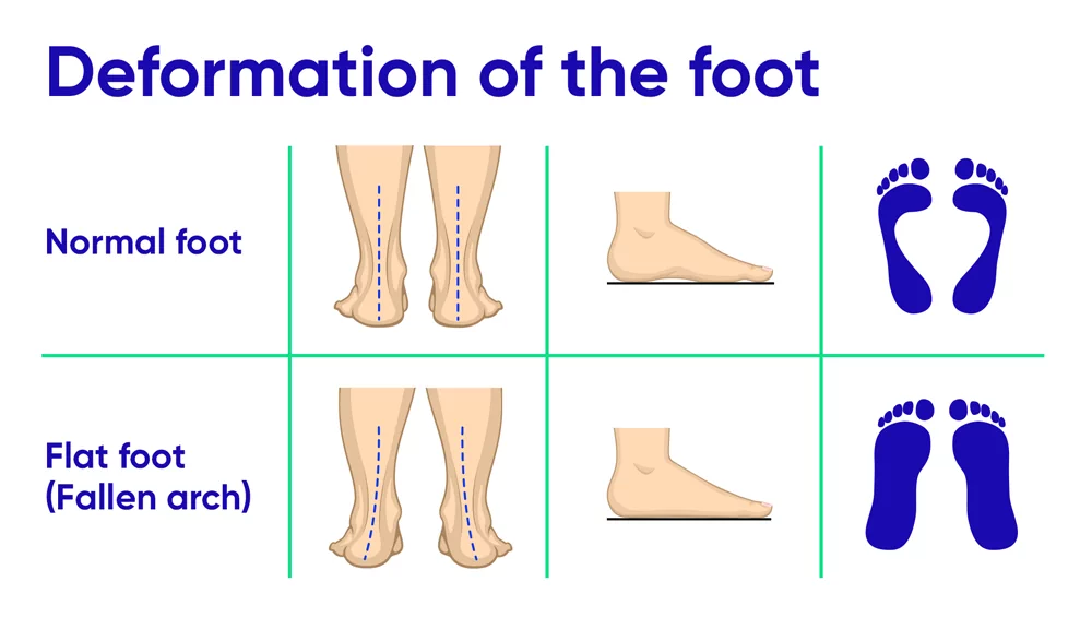 What are the symptoms of flat feet?