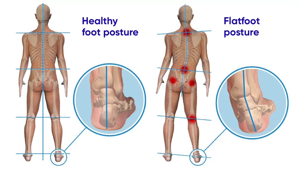 Flat feet cause serious health consequences