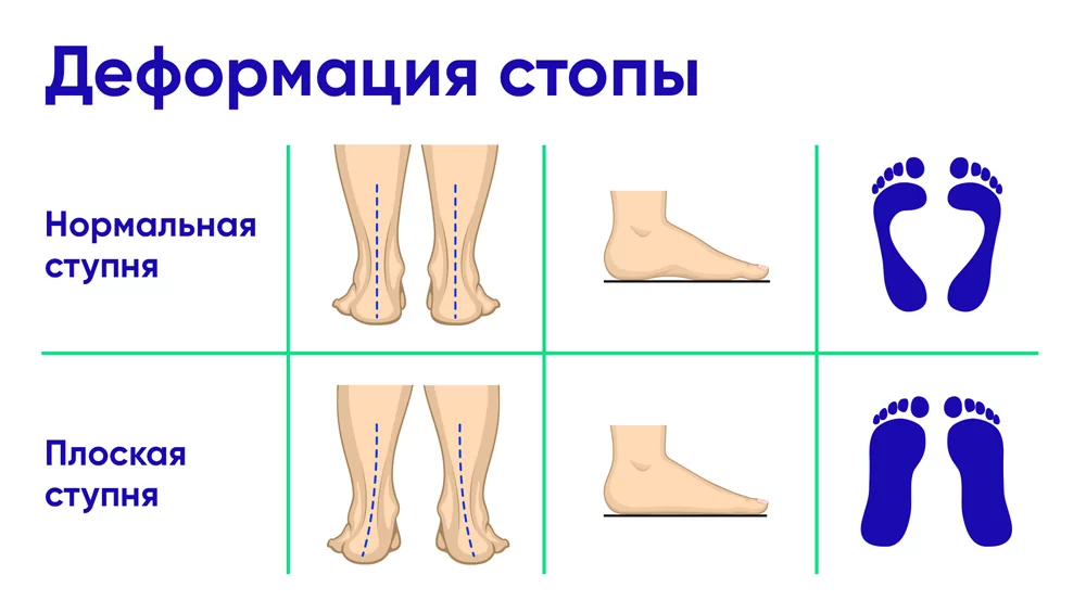 Какие симптомы плоскостопия?