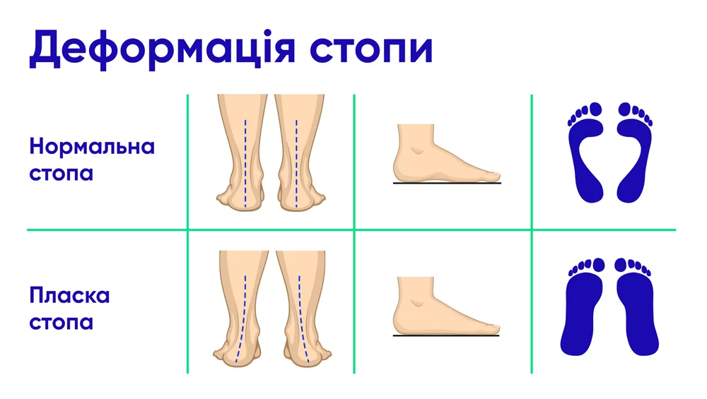Які симптоми плоскостопості?