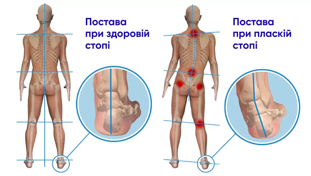 Плоскостопість має серйозні наслідки для здоров’я