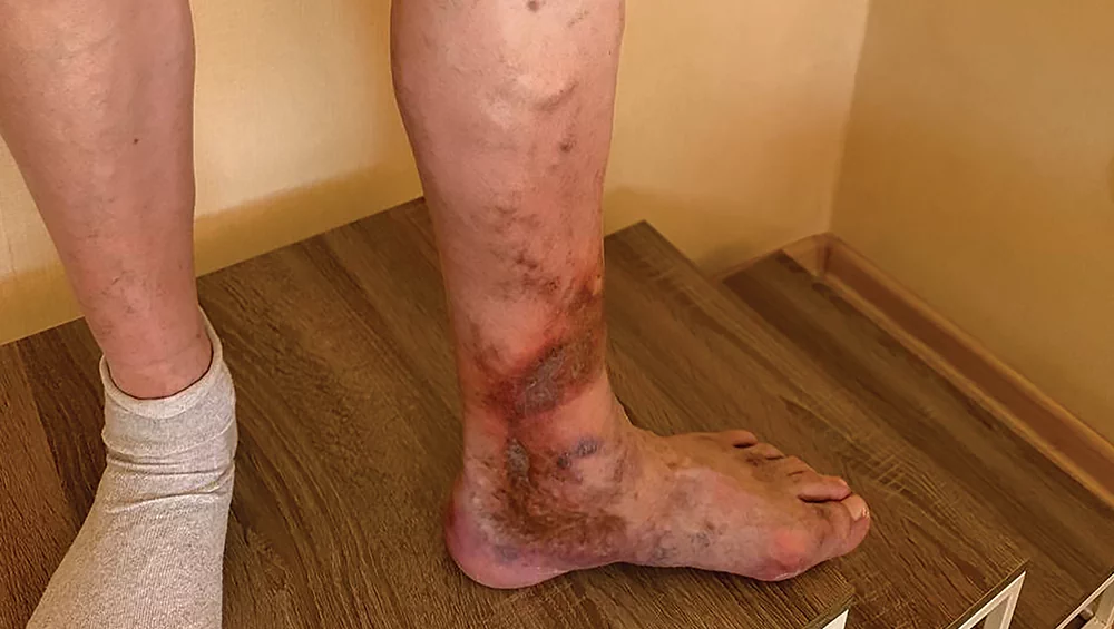 How to preserve the health of veins for many years?