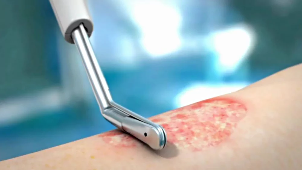 How does VersaJet™ wound debridement work?