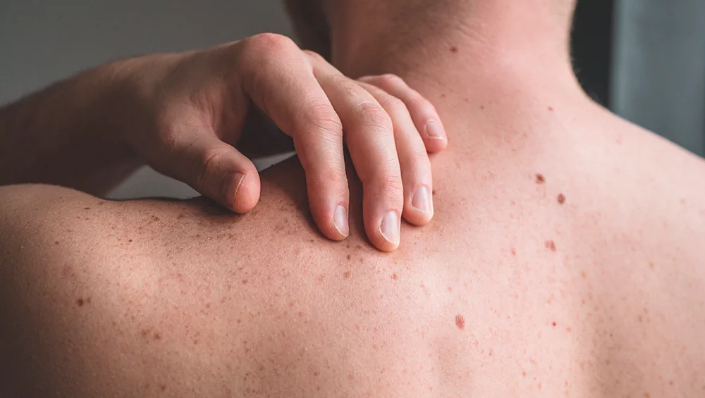 What causes pigmentation on the body - neck, back, arms?