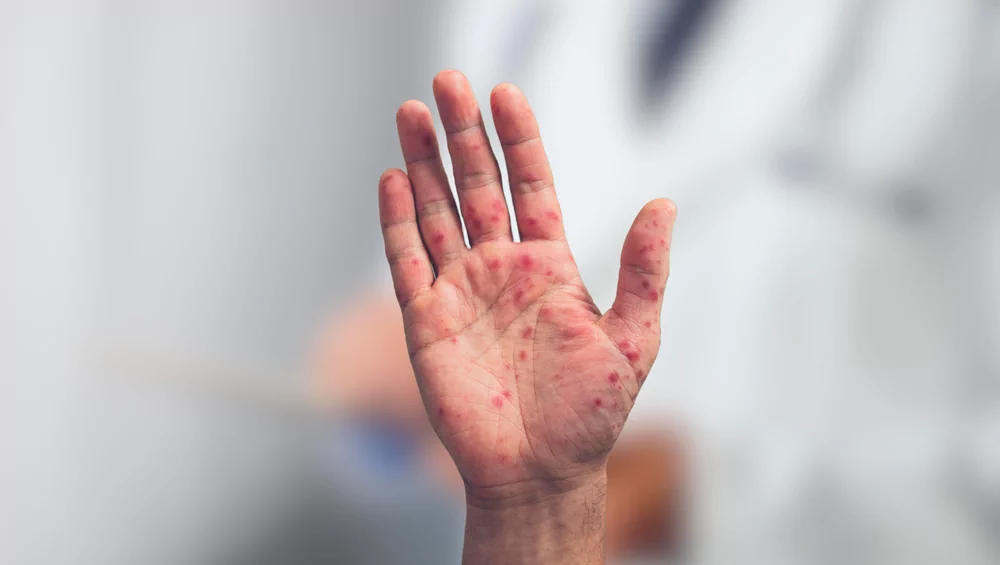 Where is the typical rash of Coxsackievirus localized, and what does it look like?