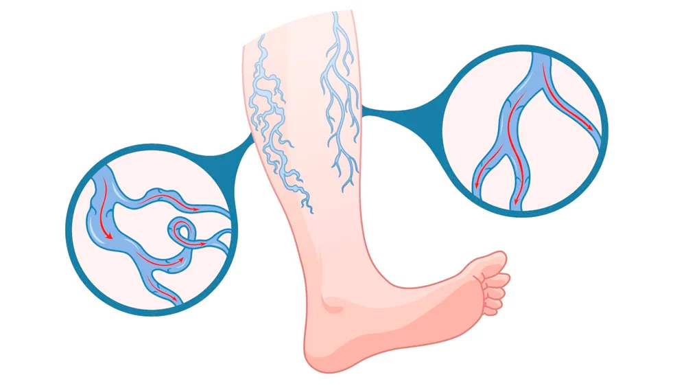 What Are Varicose Veins and Why Do They Develop?