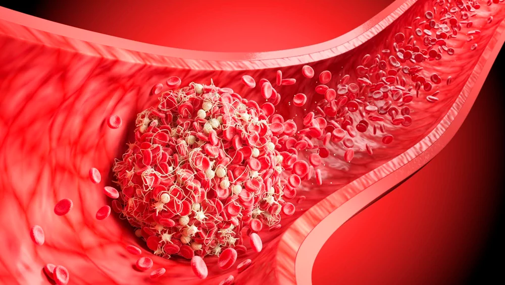 Why Blood Clots Are Dangerous: Symptoms and Consequences