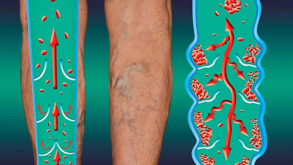 What Is a Blood Clot and What Is Thrombosis?