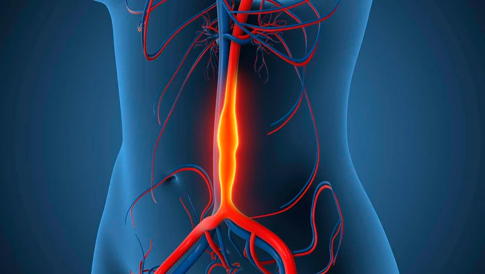Abdominal Aortic Aneurysm Rupture: Modern EVAR Treatment