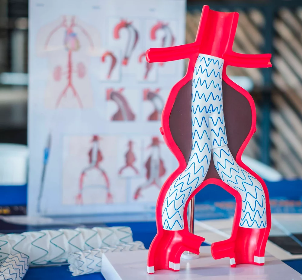 EVAR — A Modern Endovascular Treatment for Aneurysms
