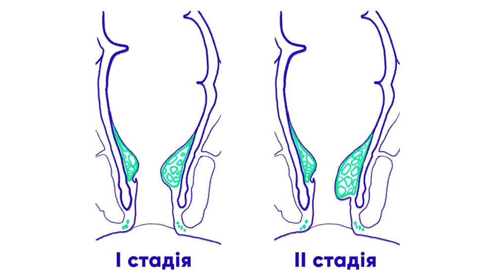 Симптоми геморою