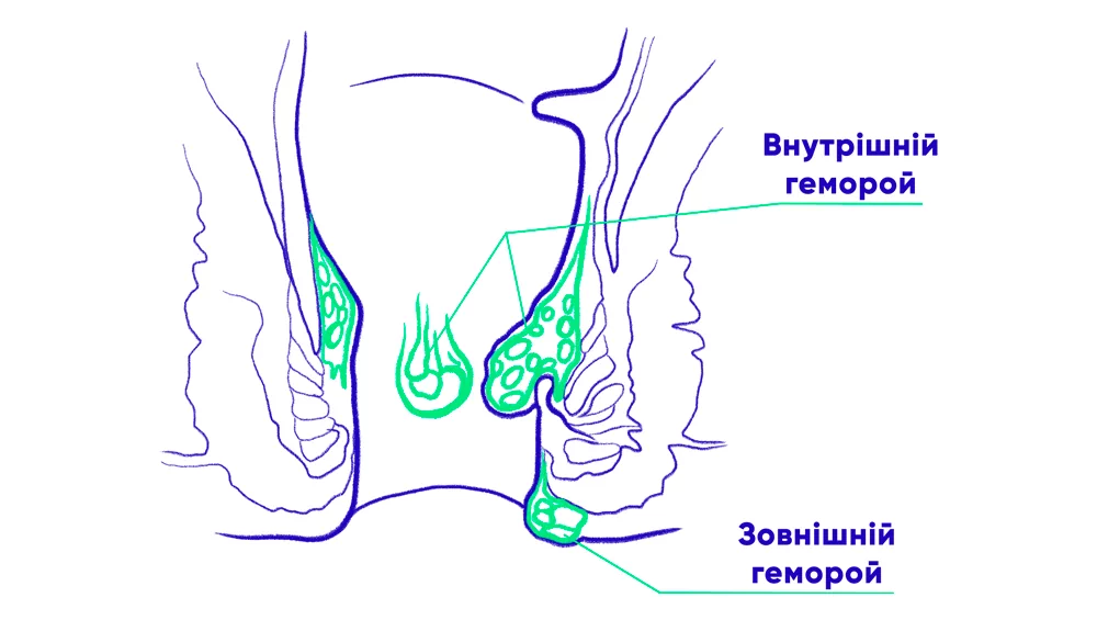 Внутрішній геморой