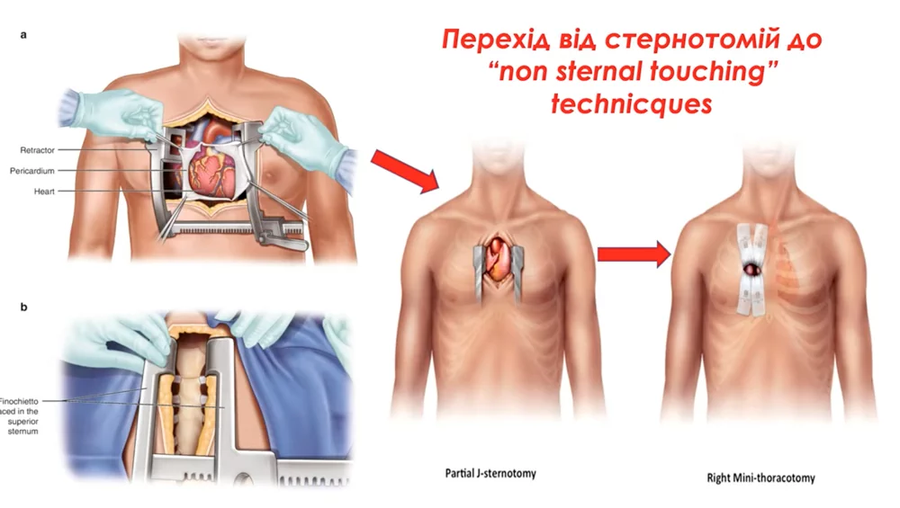Why minimally invasive cardiac surgery has become a new stage in the development of cardiac surgery